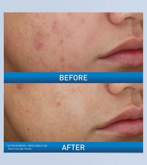 Acne Foaming Cream Wash - 150ml-CeraVe-Noura Skincare