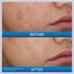 Acne Foaming Cream Wash - 150ml-CeraVe-Noura Skincare