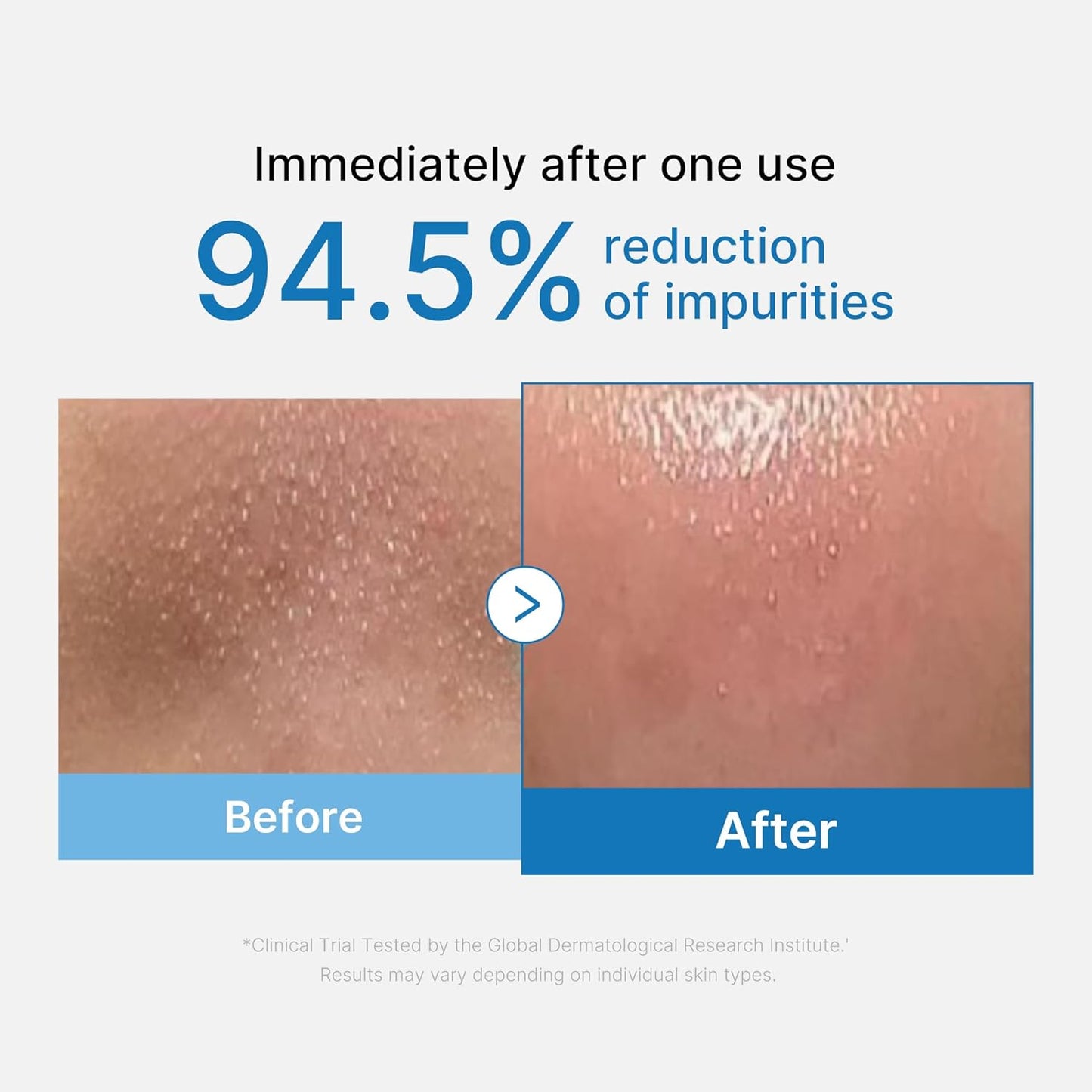 Before and after comparison of skin impurities reduction with text indicating 94.5% reduction after one use.